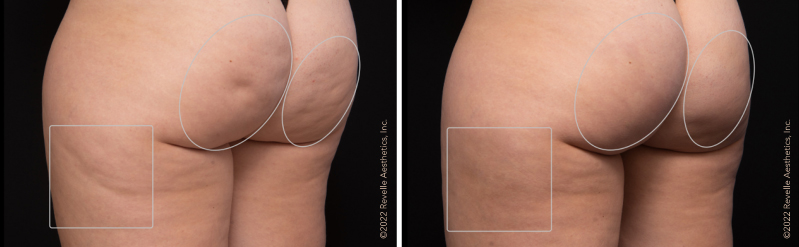 Avéli™ Cellulite Treatment in Houston, TX