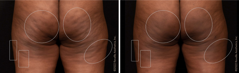 Avéli® Cellulite Reduction: A Non-Surgical Solution for Smoother Skin