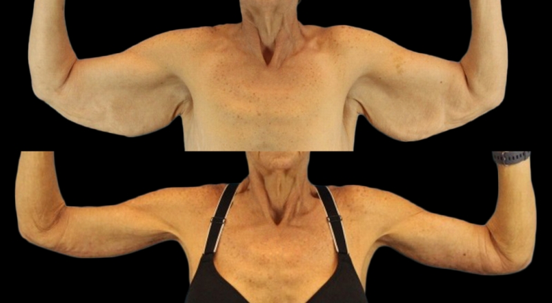 Arm Lift Before & After Patient #3985