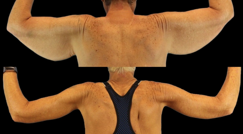 Arm Lift Before & After Patient #3985
