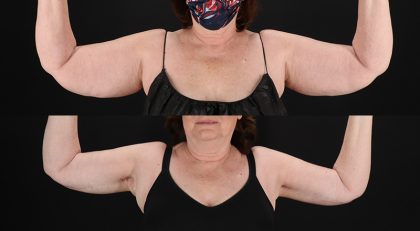 Arm Lift Before & After Patient #3994