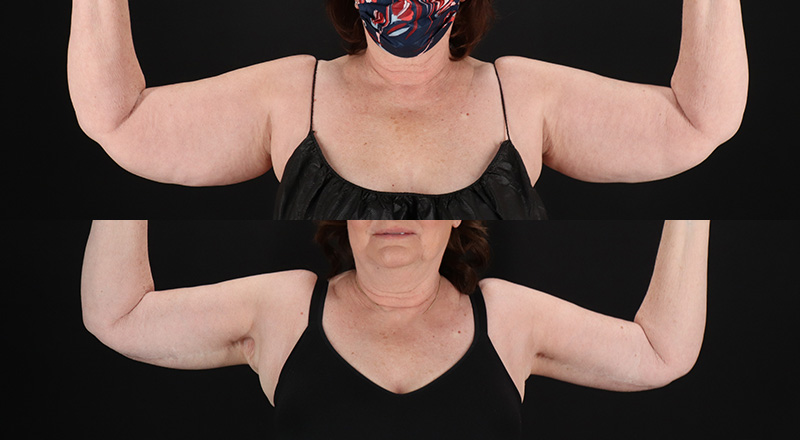 Arm Lift Before & After Patient #3994