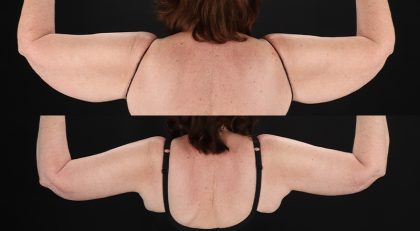 Arm Lift Before & After Patient #3994