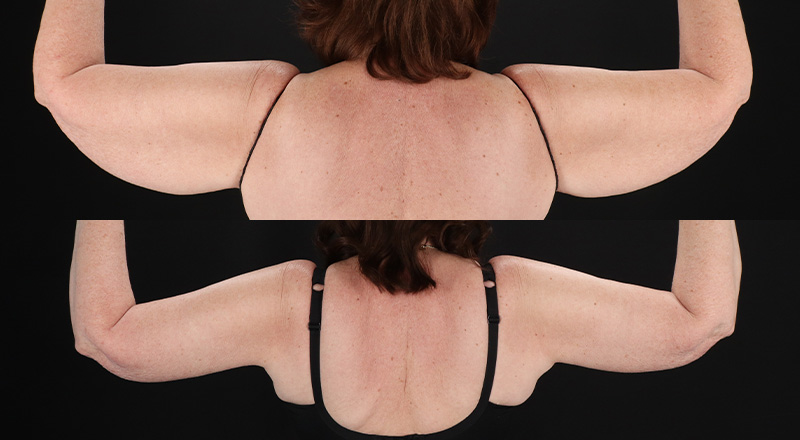 Arm Lift Before & After Patient #3994
