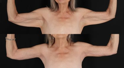 Arm Lift Before & After Patient #3995