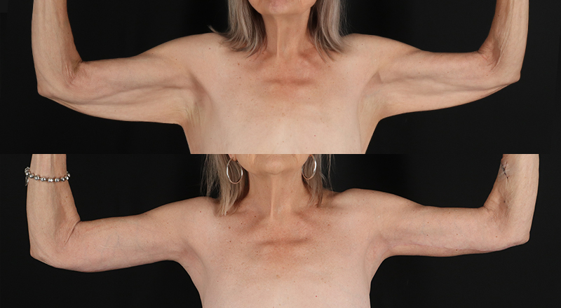 Arm Lift Before & After Patient #3995