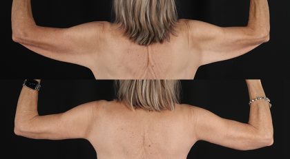 Arm Lift Before & After Patient #3995