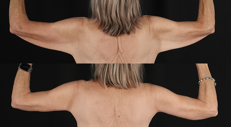 Arm Lift Before & After Patient #3995