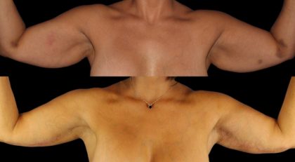 Arm Lift Before & After Patient #3986