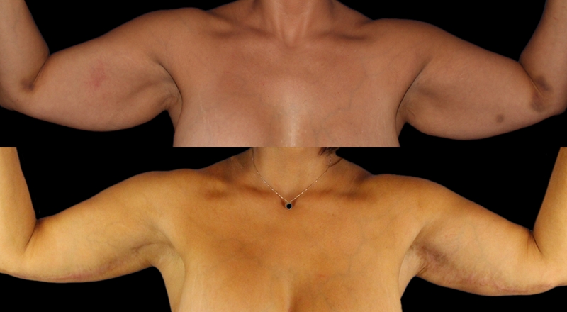 Arm Lift Before & After Patient #3986