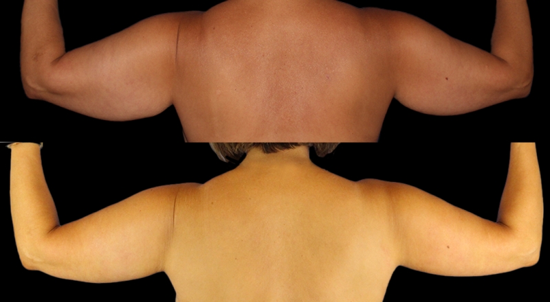 Arm Lift Before & After Patient #3986