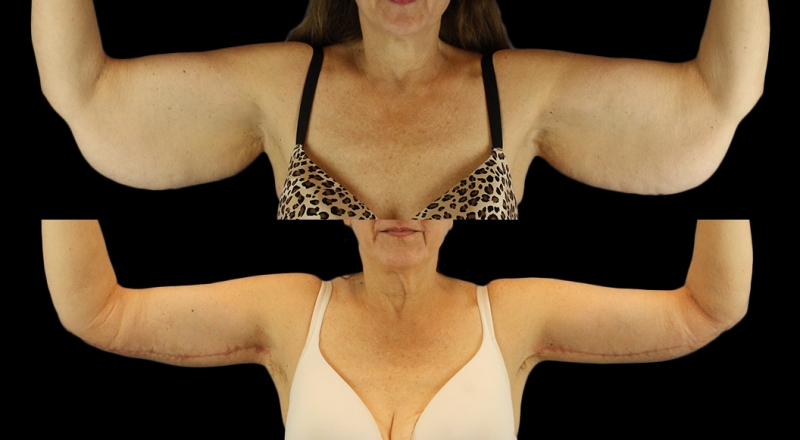 Arm Lift Before & After Patient #3987