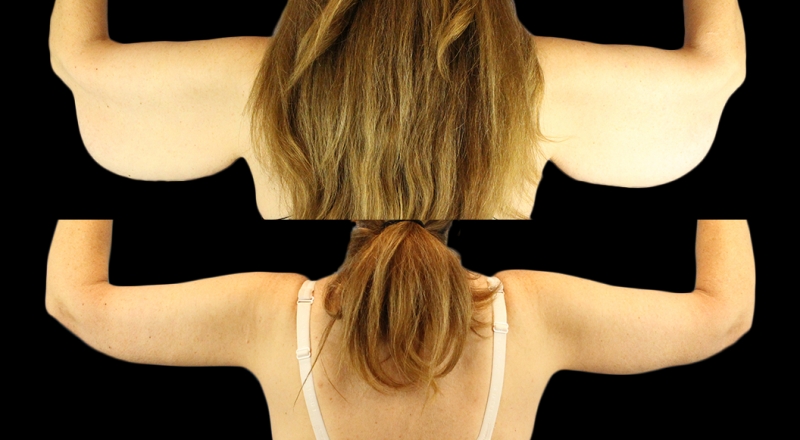 Arm Lift Before & After Patient #3987