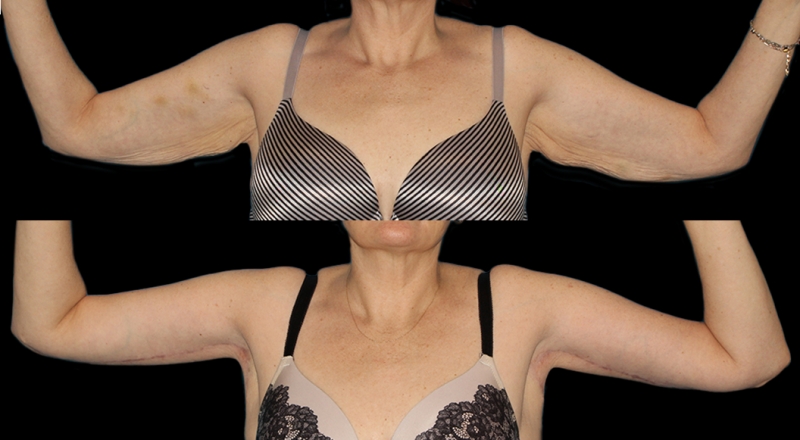 Arm Lift Before & After Patient #3988