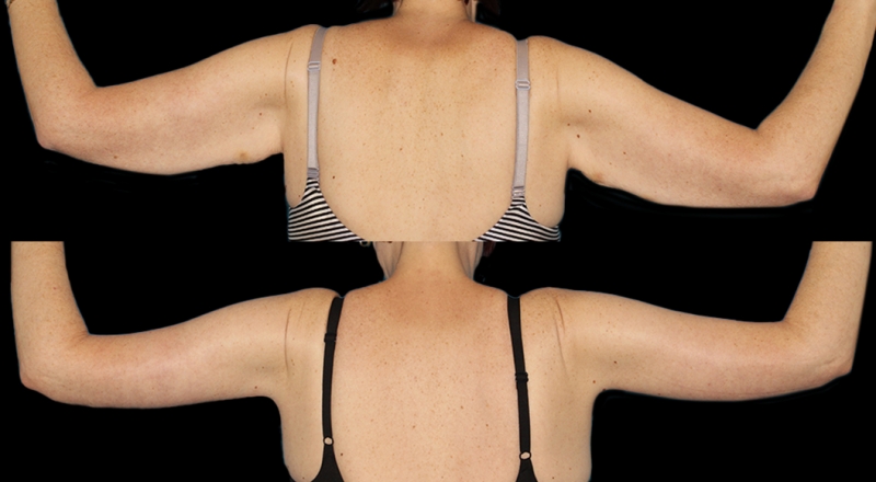 Arm Lift Before & After Patient #3988