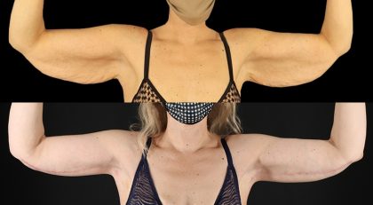 Arm Lift Before & After Patient #3989