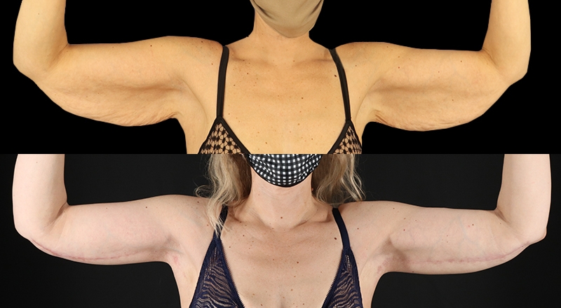 Arm Lift Before & After Patient #3989