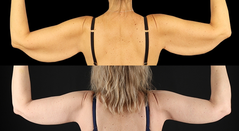 Arm Lift Before & After Patient #3989