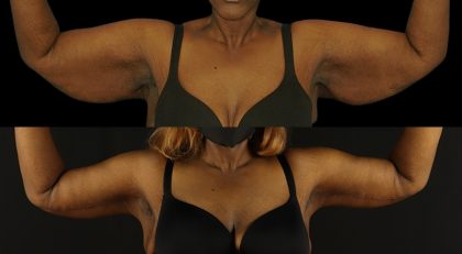 Arm Lift Before & After Patient #3990