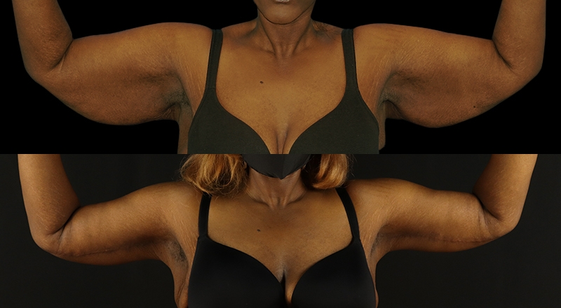 Arm Lift Before & After Patient #3990