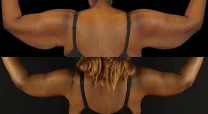 Arm Lift Before & After Patient #3990