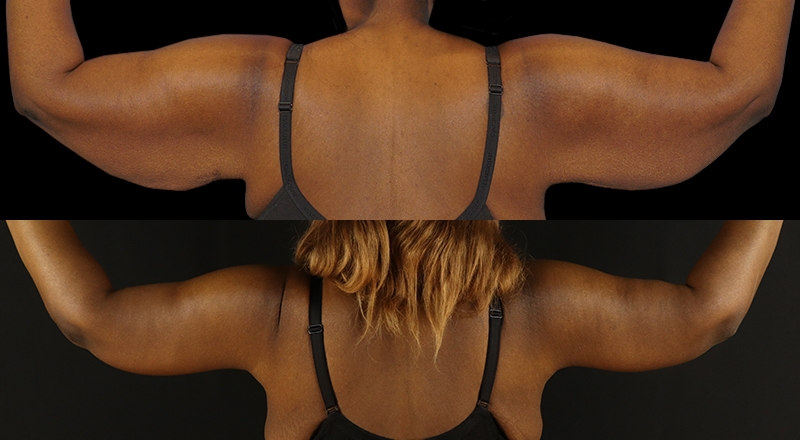 Arm Lift Before & After Patient #3990