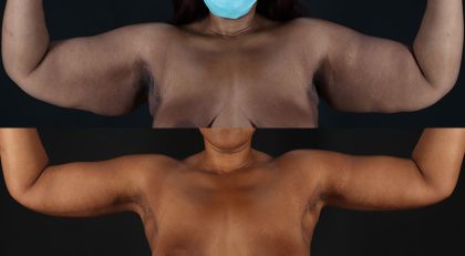 Arm Lift Before & After Patient #3991