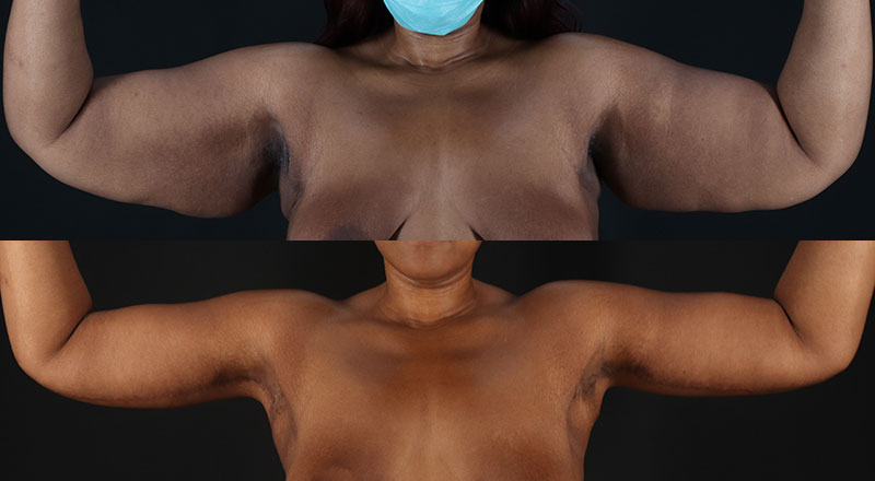 Arm Lift Before & After Patient #3991