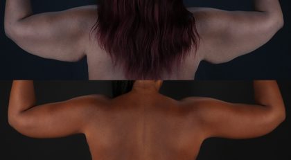 Arm Lift Before & After Patient #3991