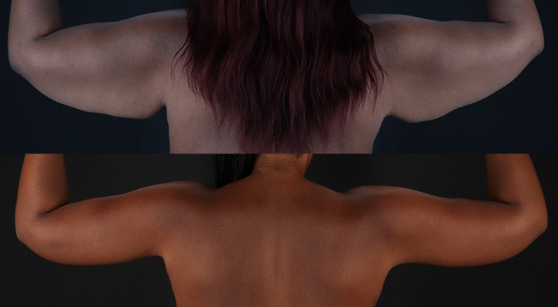 Arm Lift Before & After Patient #3991