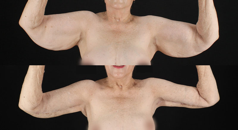 Arm Lift Before & After Patient #3992