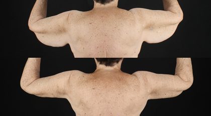 Arm Lift Before & After Patient #3992