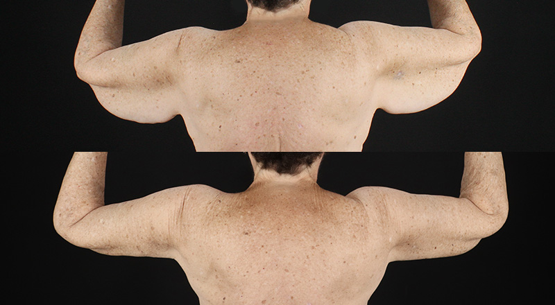 Arm Lift Before & After Patient #3992