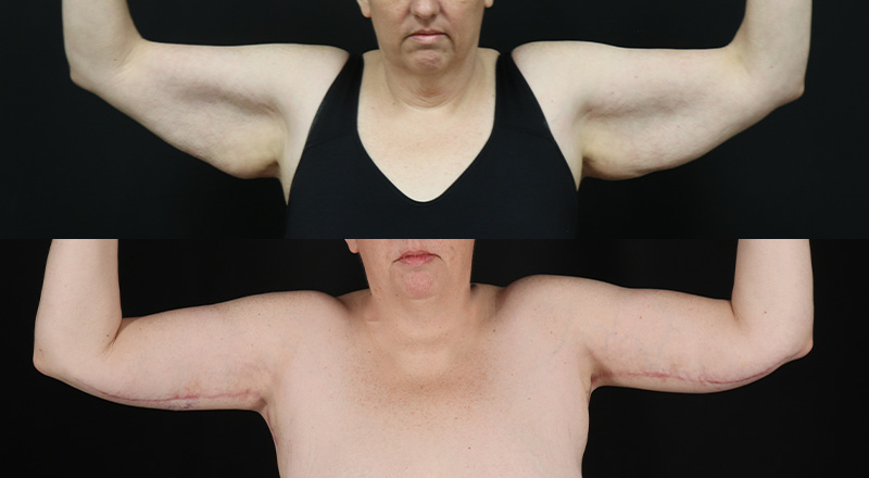 Arm Lift Before & After Patient #3993