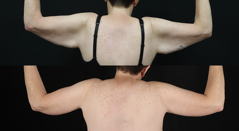 Arm Lift Before & After Patient #3993