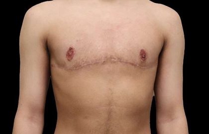 FTM Chest Contouring Before & After Patient #1929