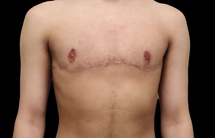 FTM Chest Contouring Before & After Patient #1929