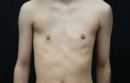 FTM Chest Contouring Before & After Patient #1940