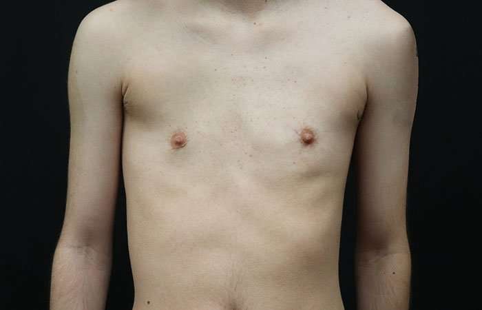 FTM Chest Contouring Before & After Patient #1940
