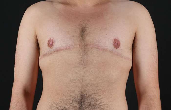 FTM Chest Contouring Before & After Patient #1951