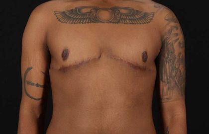 FTM Chest Contouring Before & After Patient #1962