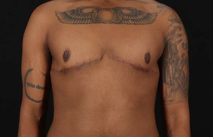 FTM Chest Contouring Before & After Patient #1962