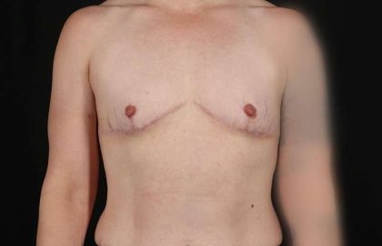 FTM Chest Contouring Before & After Patient #1973