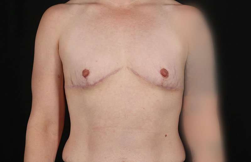 FTM Chest Contouring Before & After Patient #1973