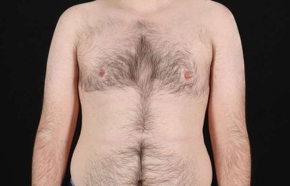 FTM Chest Contouring Before & After Patient #1984