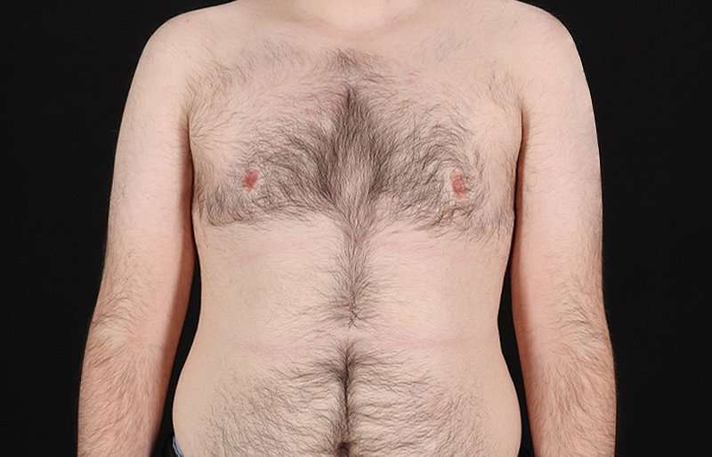 FTM Chest Contouring Before & After Patient #1984
