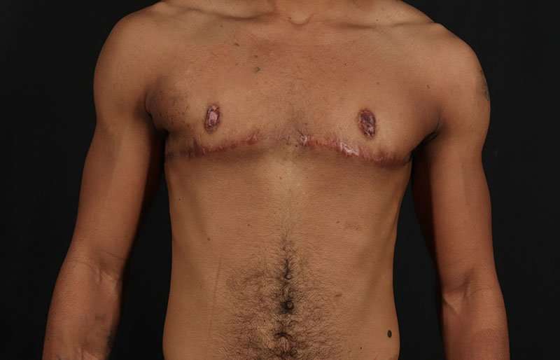 FTM Chest Contouring Before & After Patient #1995