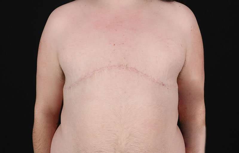 FTM Chest Contouring Before & After Patient #2006