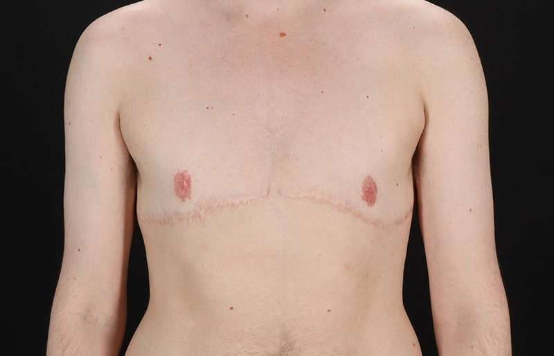 FTM Chest Contouring Before & After Patient #2017