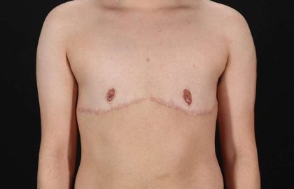 FTM Chest Contouring Before & After Patient #2028